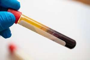 Platelet-rich plasma preparation for oral surgery