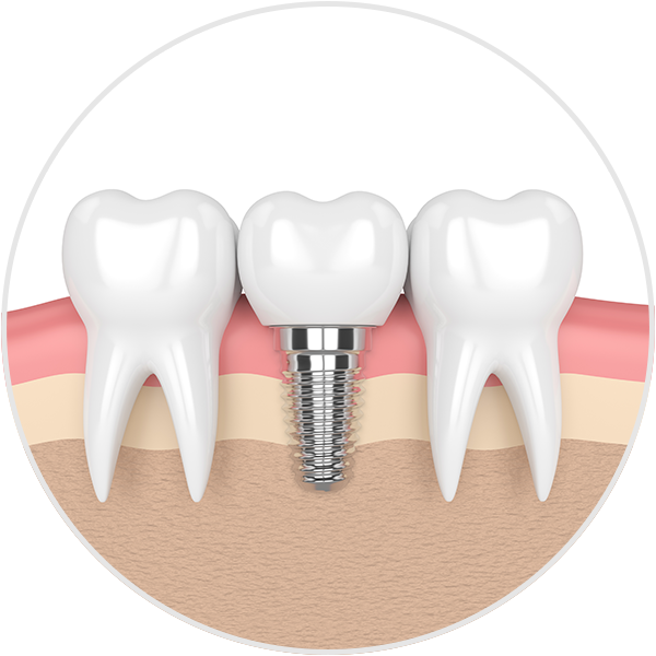 dental implants