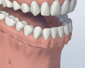 Partial denture replacing missing teeth