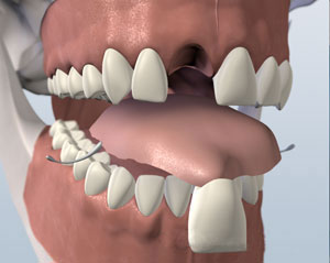 Removable flipper denture replacing missing teeth
