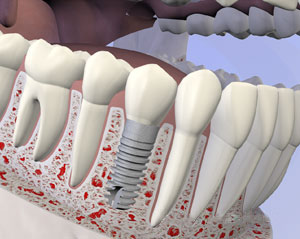 Dental implant replacing a missing tooth