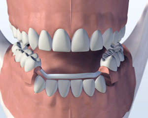 Metal partial denture replacing missing teeth