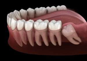 Impacted wisdom teeth illustration