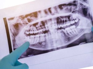 Wisdom Teeth Removal Risks