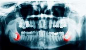Panoramic dental X-ray showing impacted wisdom teeth